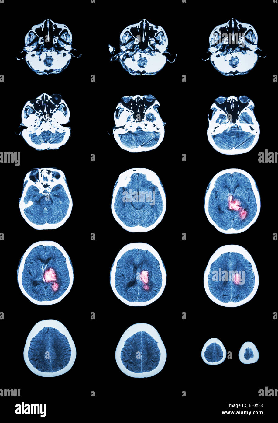 Avc hémorragique . La tomodensitométrie (CT scan) de cerveau (système cérébrovasculaire ) : l'hémorragie intracérébrale à gauche cer Banque D'Images