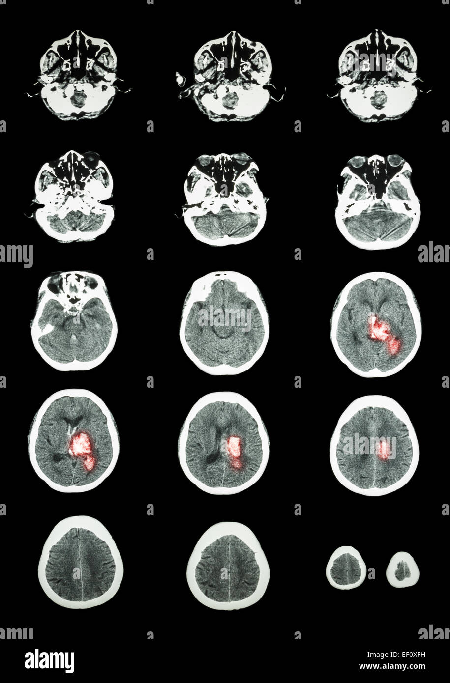Avc hémorragique . La tomodensitométrie (CT scan) de cerveau (système cérébrovasculaire ) : l'hémorragie intracérébrale à gauche cer Banque D'Images
