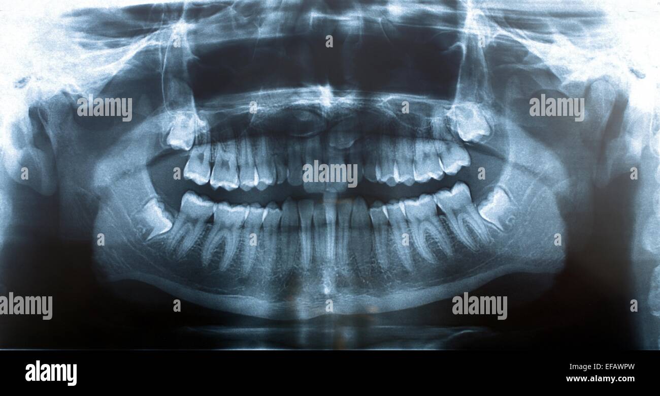 Panoramic x-ray image de dents Banque D'Images
