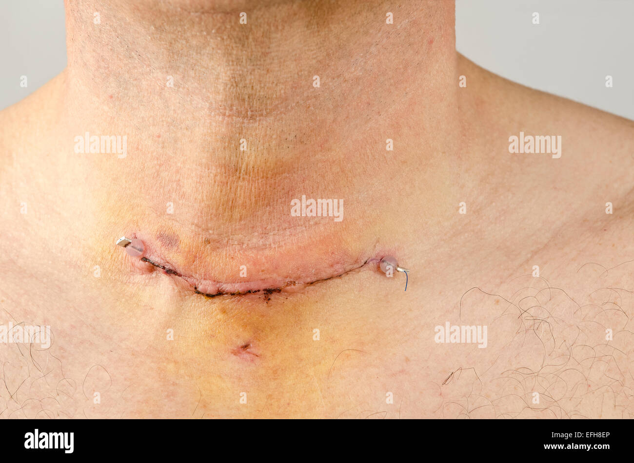 Cicatrice post-opératoire de la plaie et de la croix de la thyroïdectomie  montrant également où a été inséré de presse disponible pour certaines  utilisations Photo Stock - Alamy