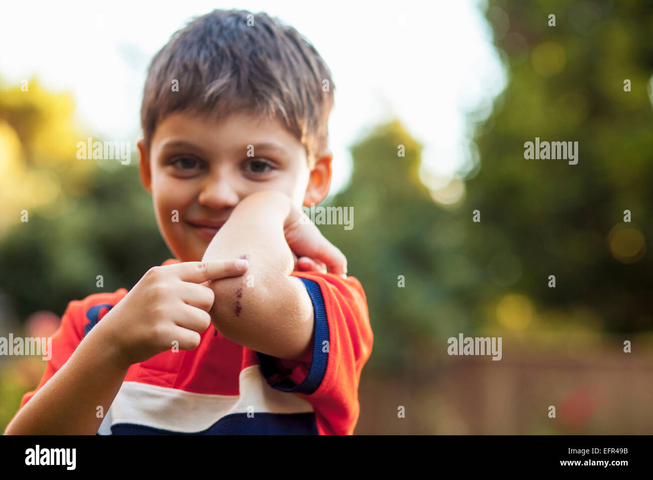 Boy pointing at ecchymose sur le coude Banque D'Images