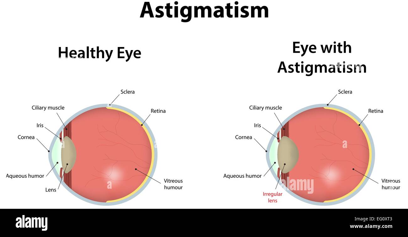 Astigmatisme Illustration de Vecteur