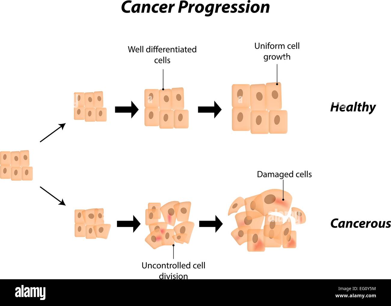 L'évolution du cancer Illustration de Vecteur