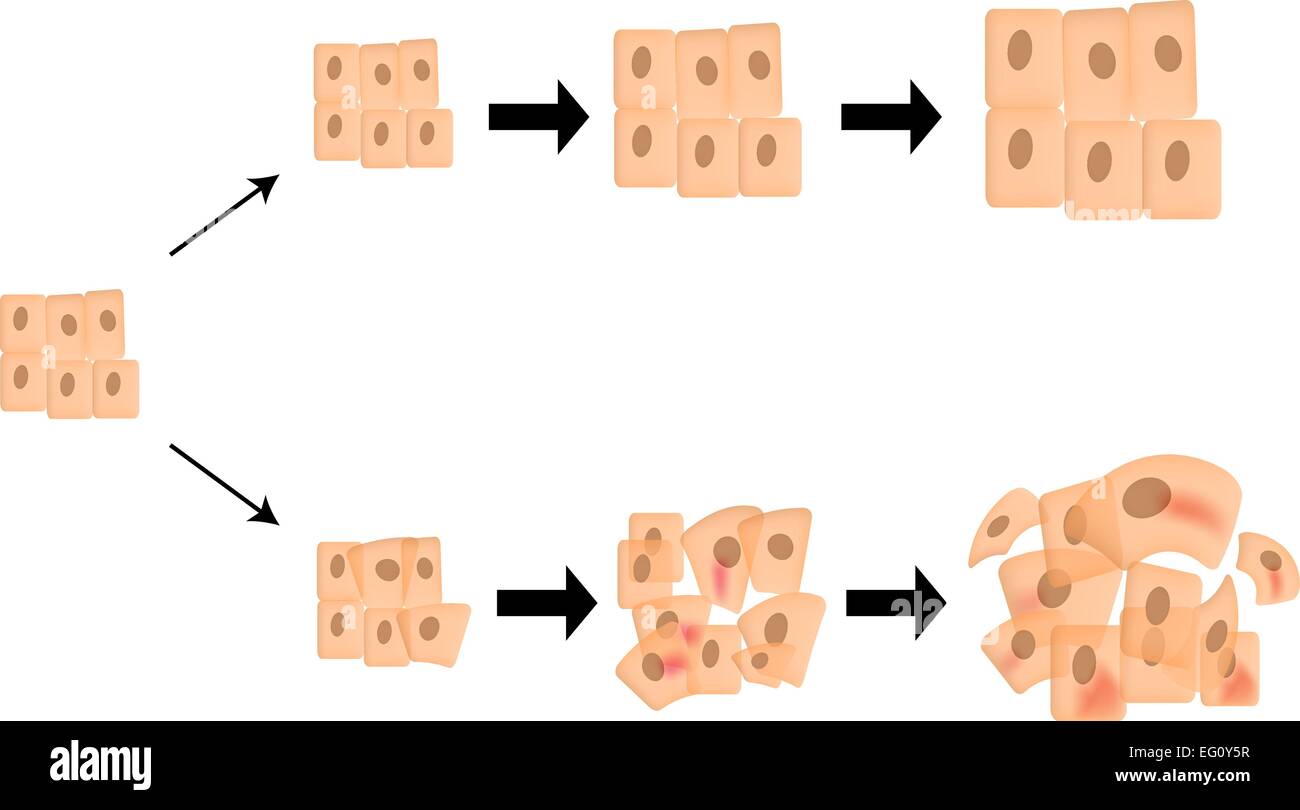 L'évolution du cancer Illustration de Vecteur