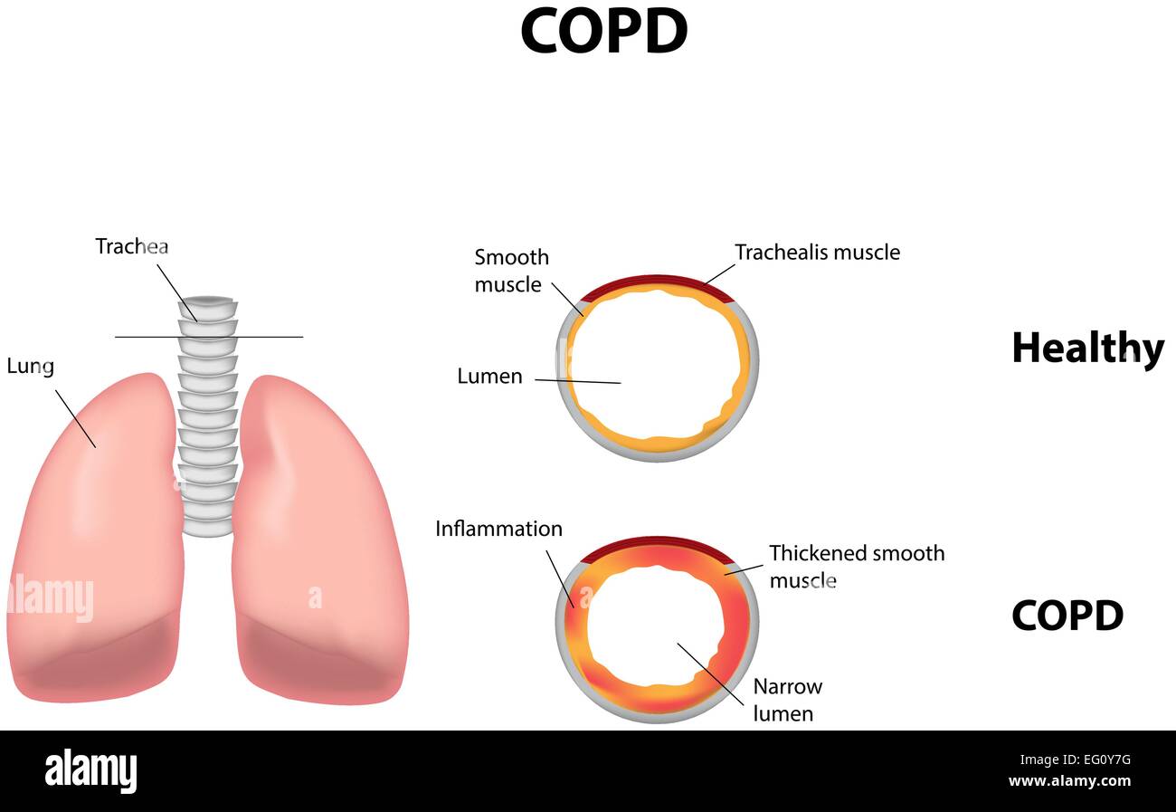 La MPOC La maladie pulmonaire obstructive chronique Illustration de Vecteur