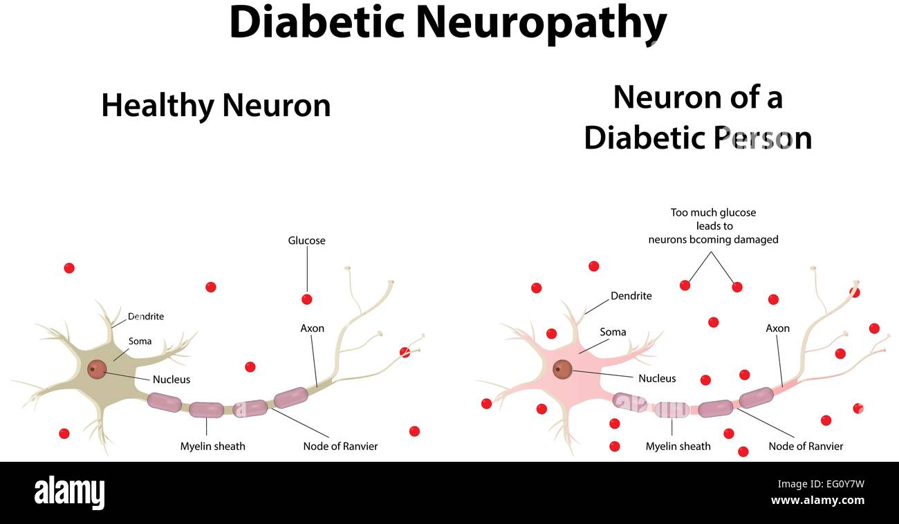 La neuropathie diabétique Illustration de Vecteur