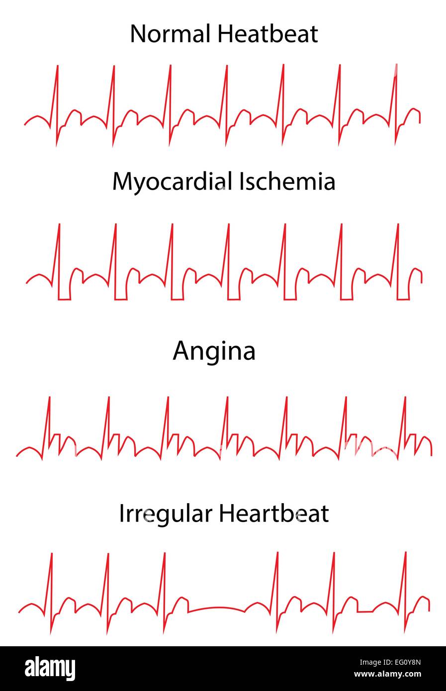 La maladie cardiaque EKG ECG Illustration de Vecteur