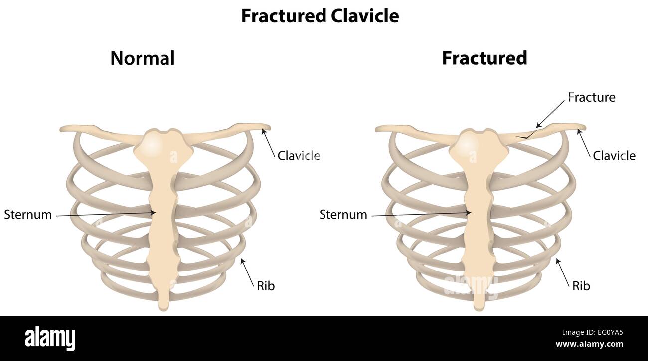 Fracture de la clavicule. Illustration de Vecteur