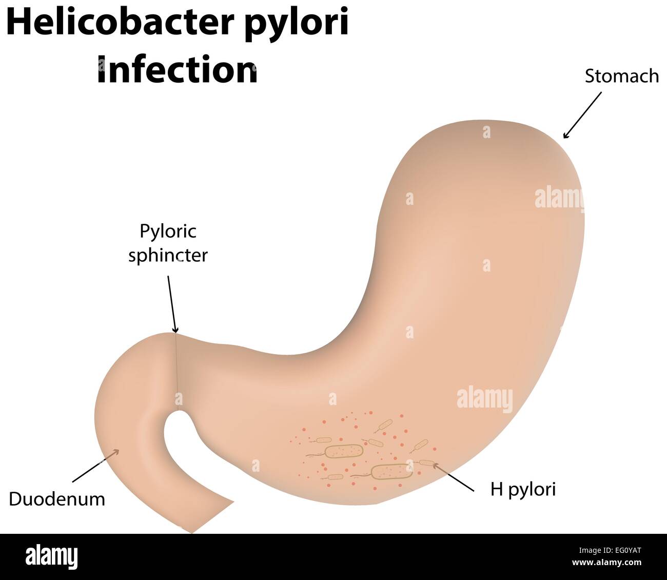 L'infection à Helicobacter pylori Illustration de Vecteur