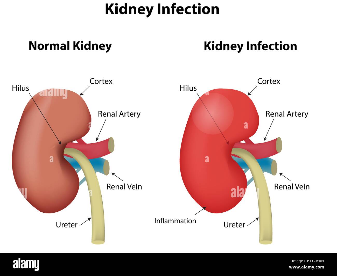 L'infection de rein Illustration de Vecteur