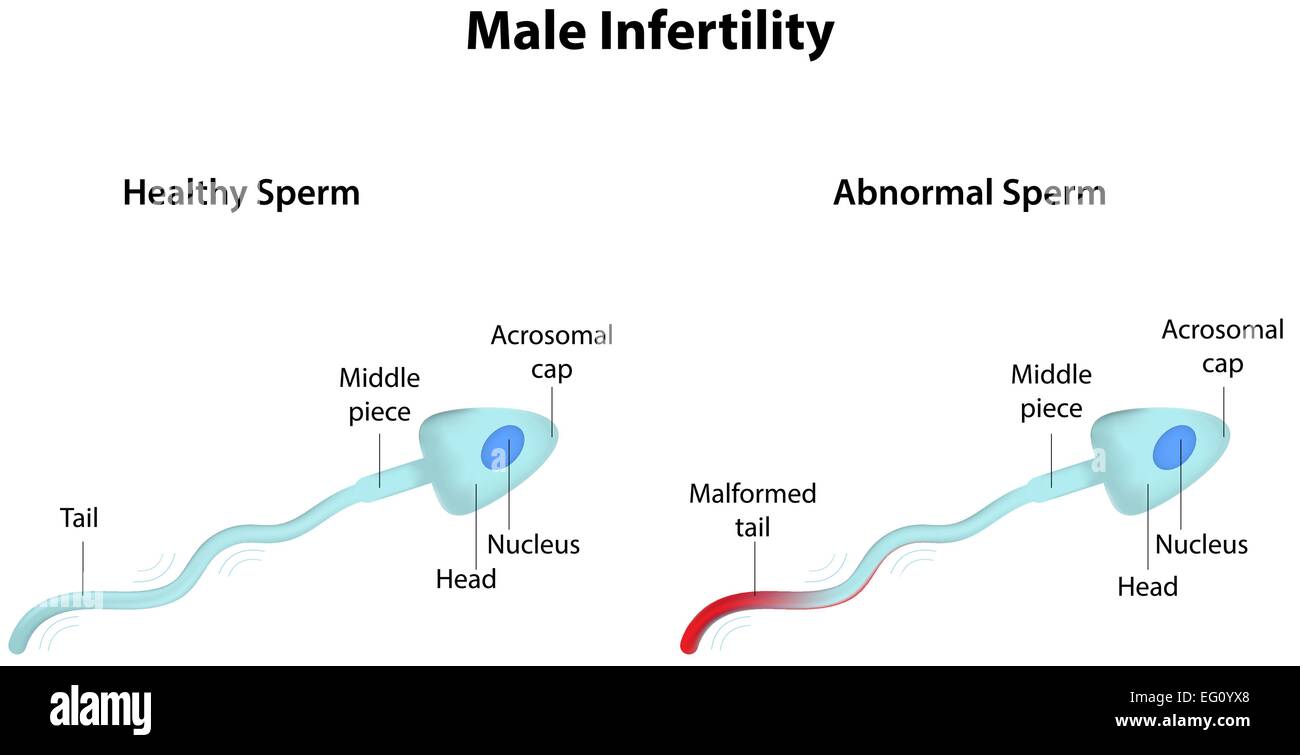 L'infertilité masculine Illustration de Vecteur