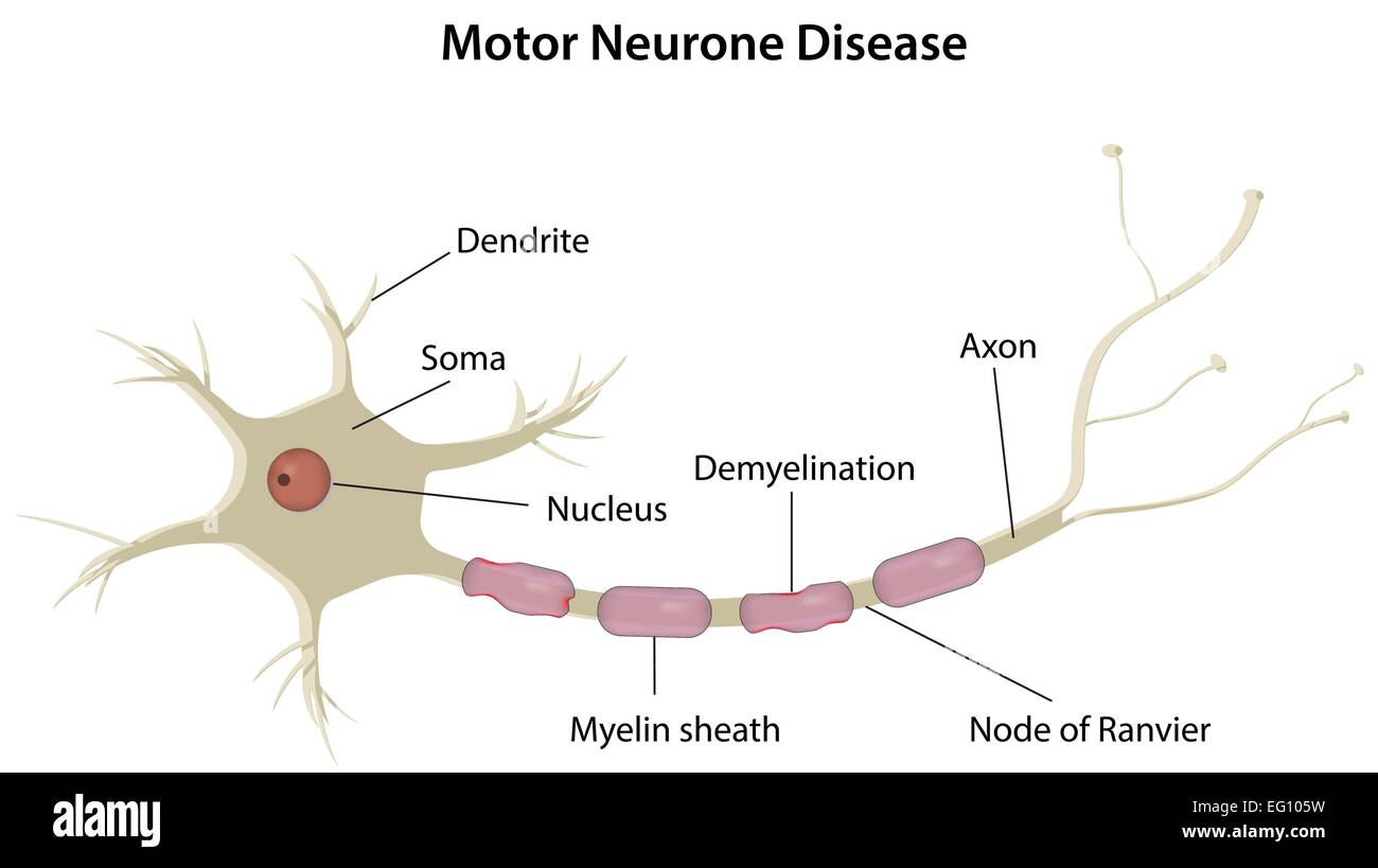 Motor neurone Disease Illustration de Vecteur