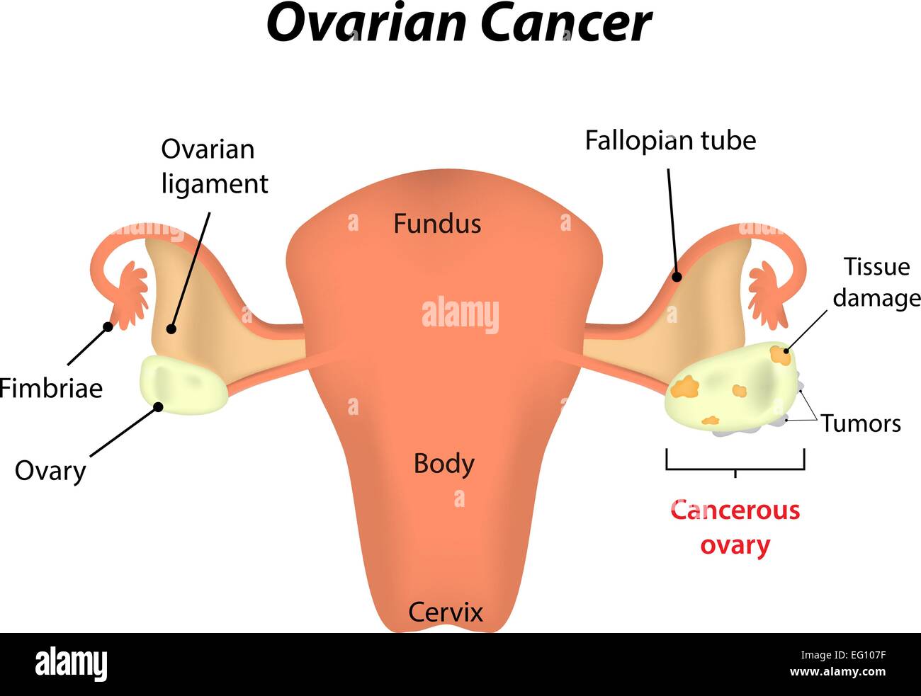 Cancer de l’ovaire Illustration de Vecteur