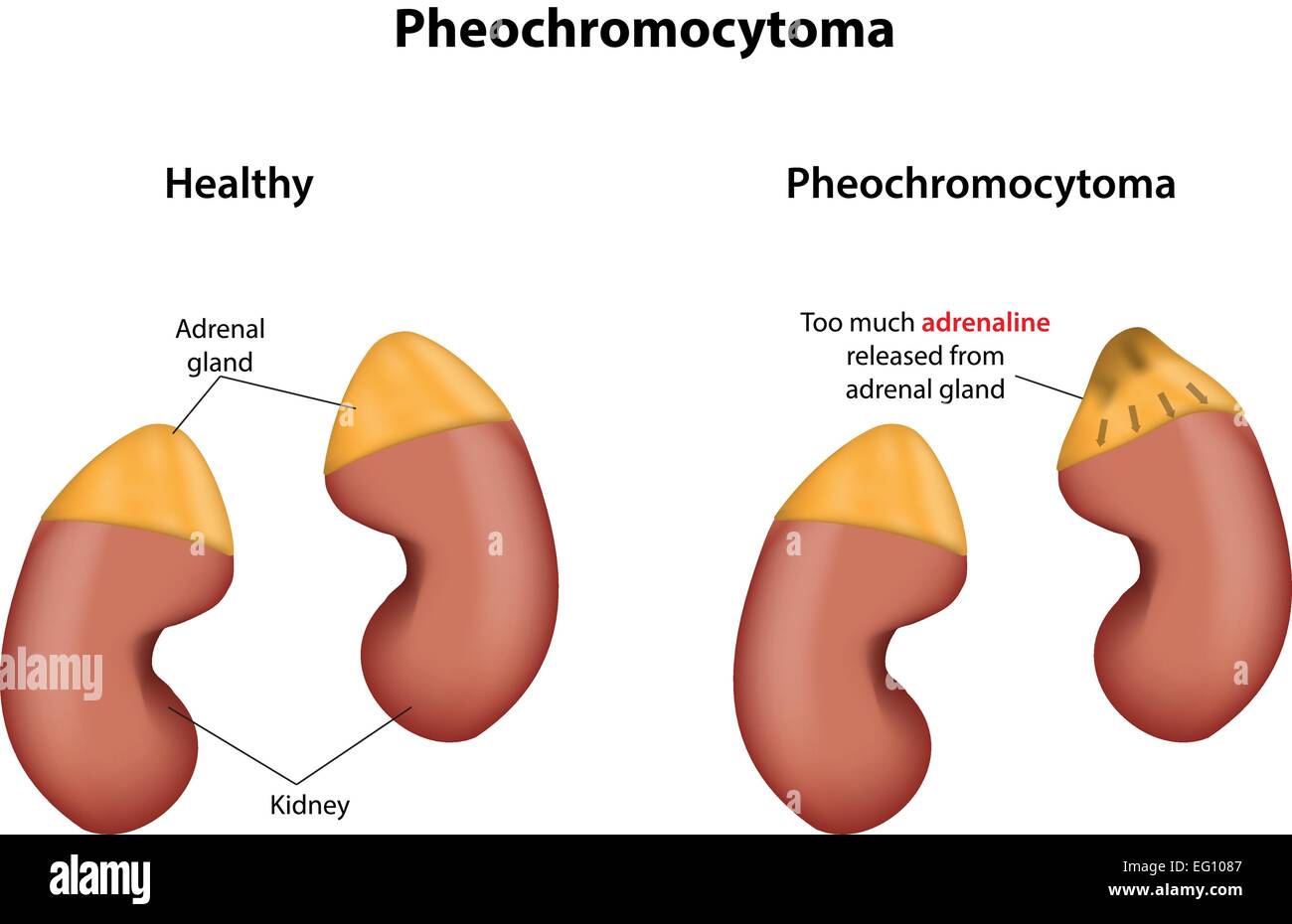Phéochromocytome Illustration de Vecteur