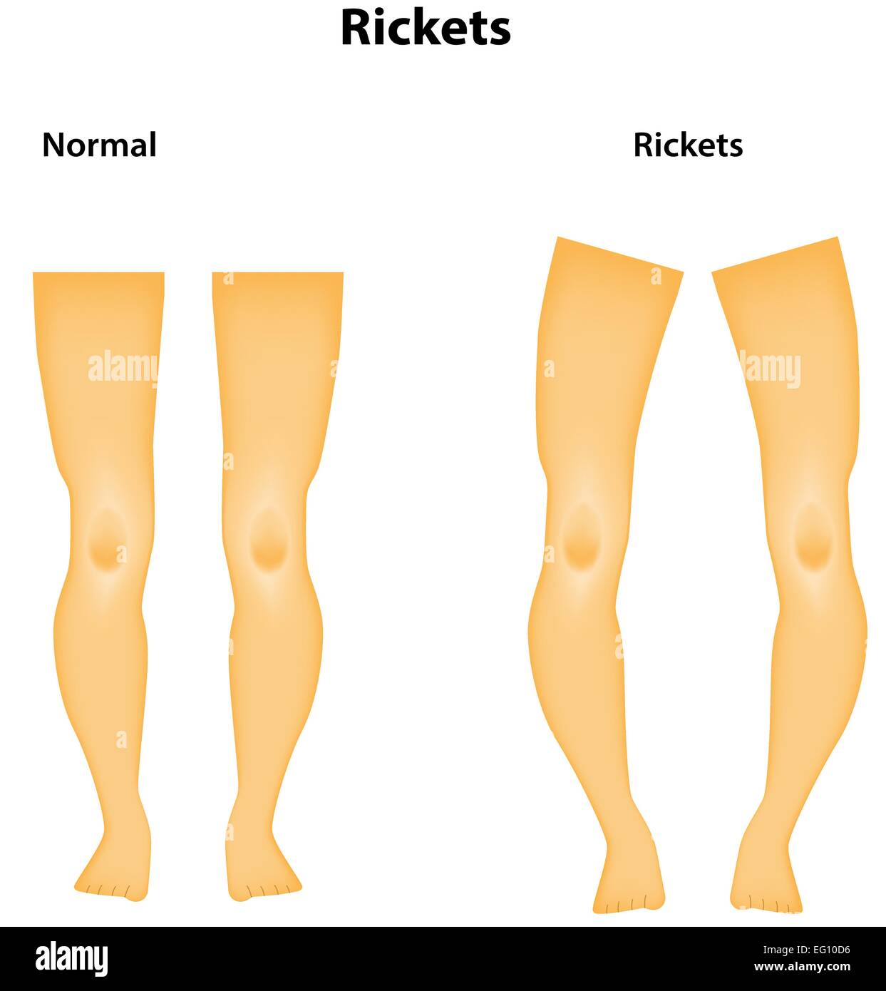 Diagramme de rachitisme Illustration de Vecteur