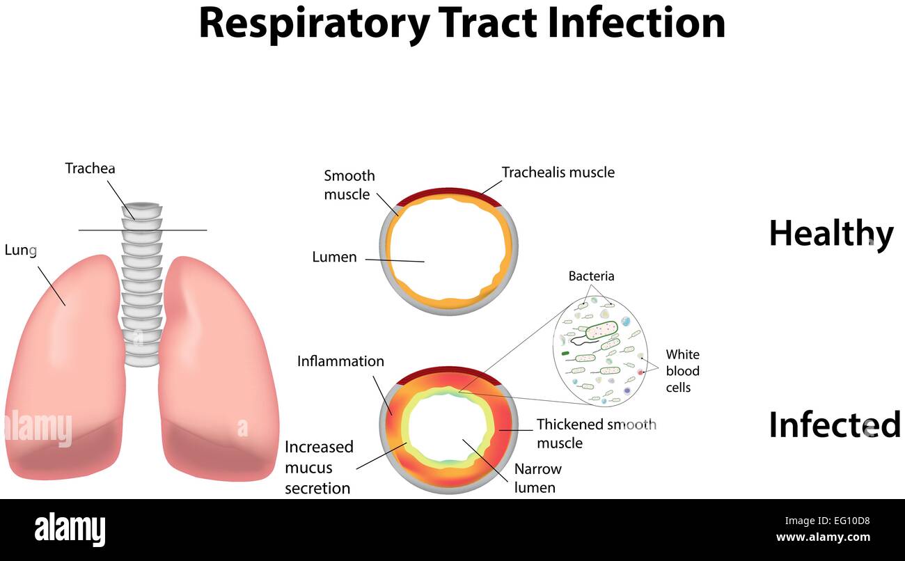 L'infection des voies respiratoires Illustration de Vecteur