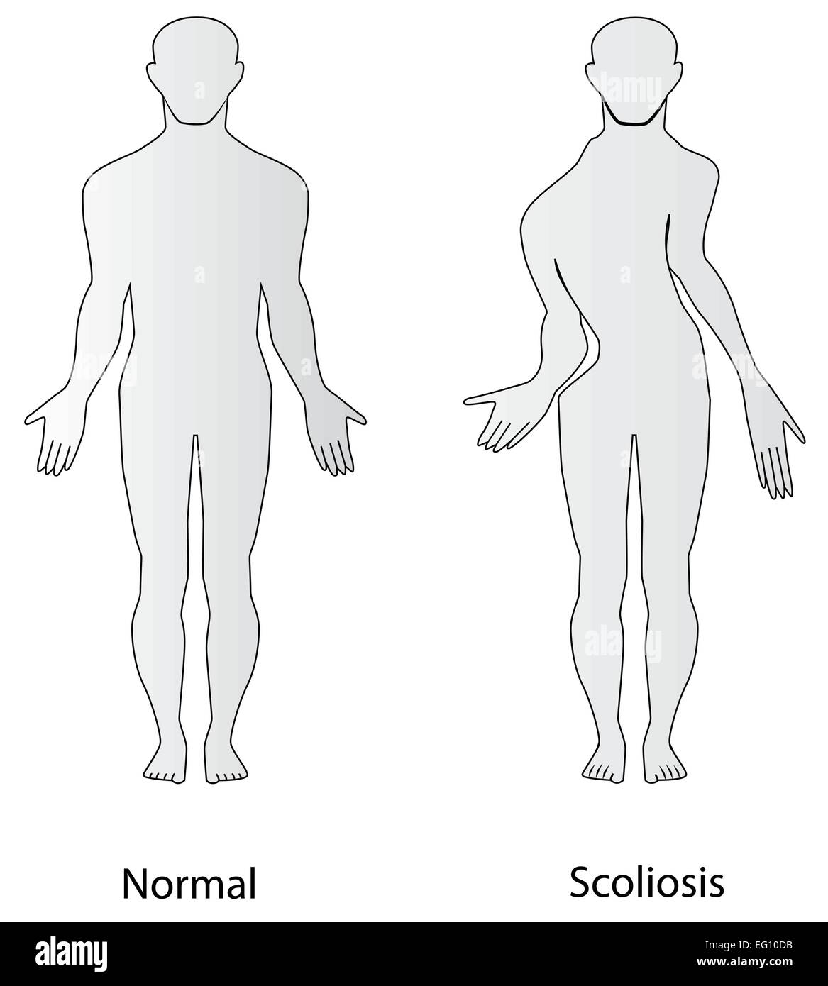Scoliose Illustration de Vecteur