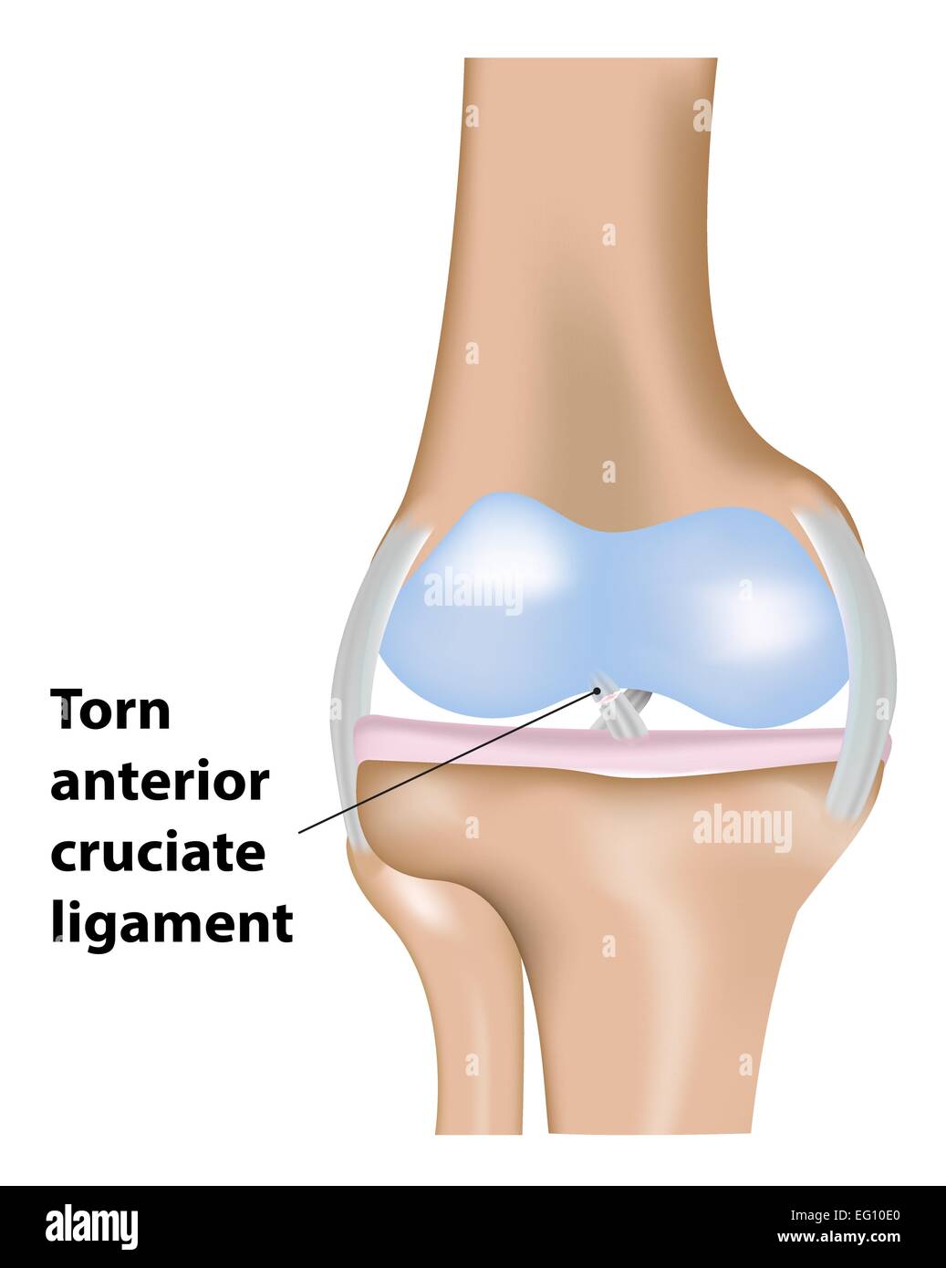 Ligament Croisé Antérieur déchiré Illustration de Vecteur