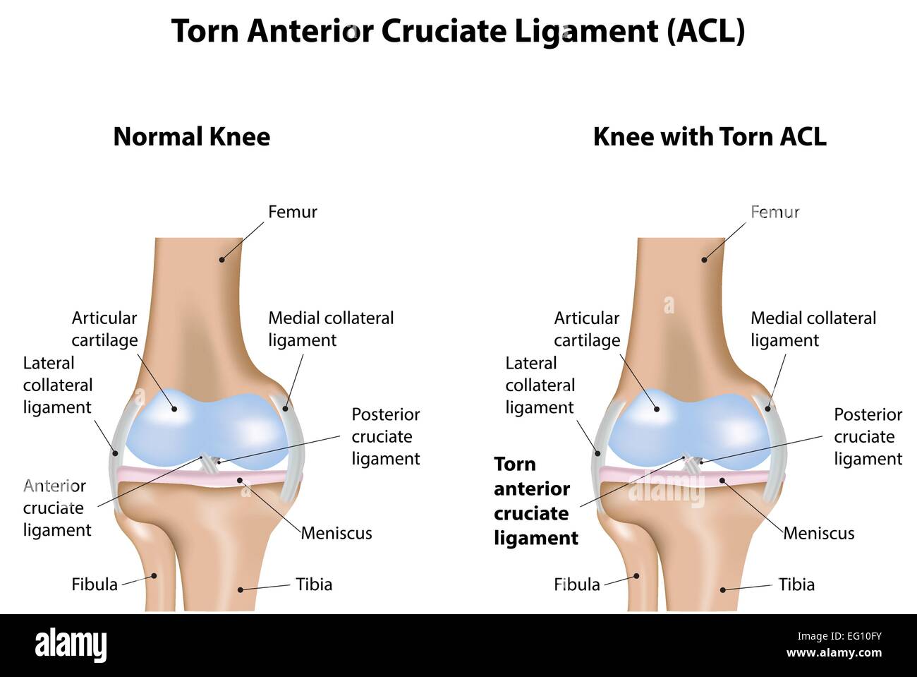 Ligament Croisé Antérieur déchiré Illustration de Vecteur