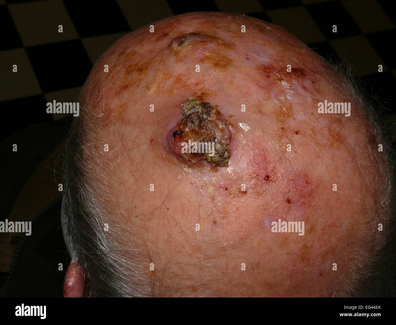 Le carcinome à cellules squameuses du cuir chevelu Banque D'Images
