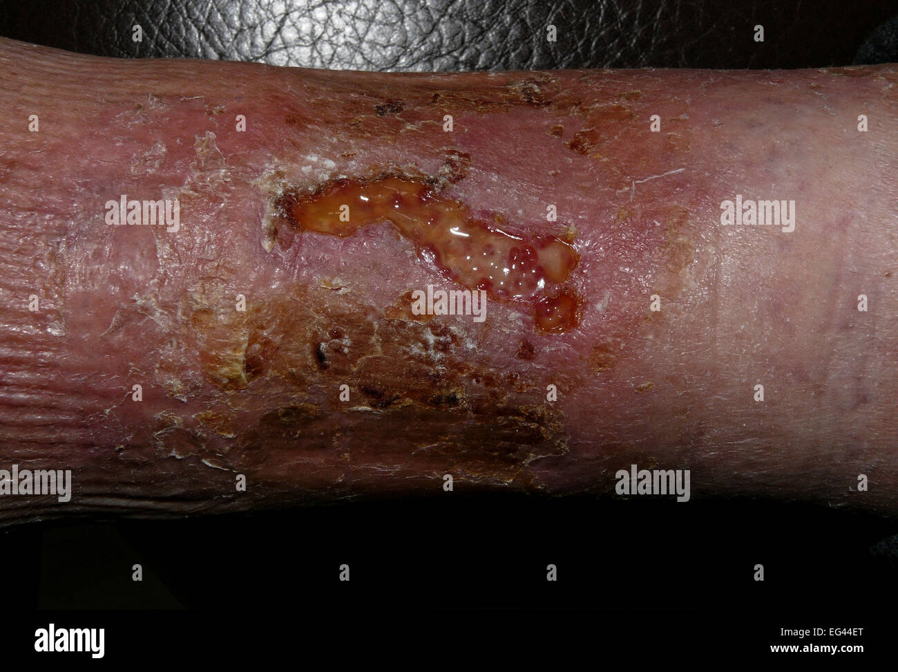 Morsure infectées de la jambe Banque D'Images