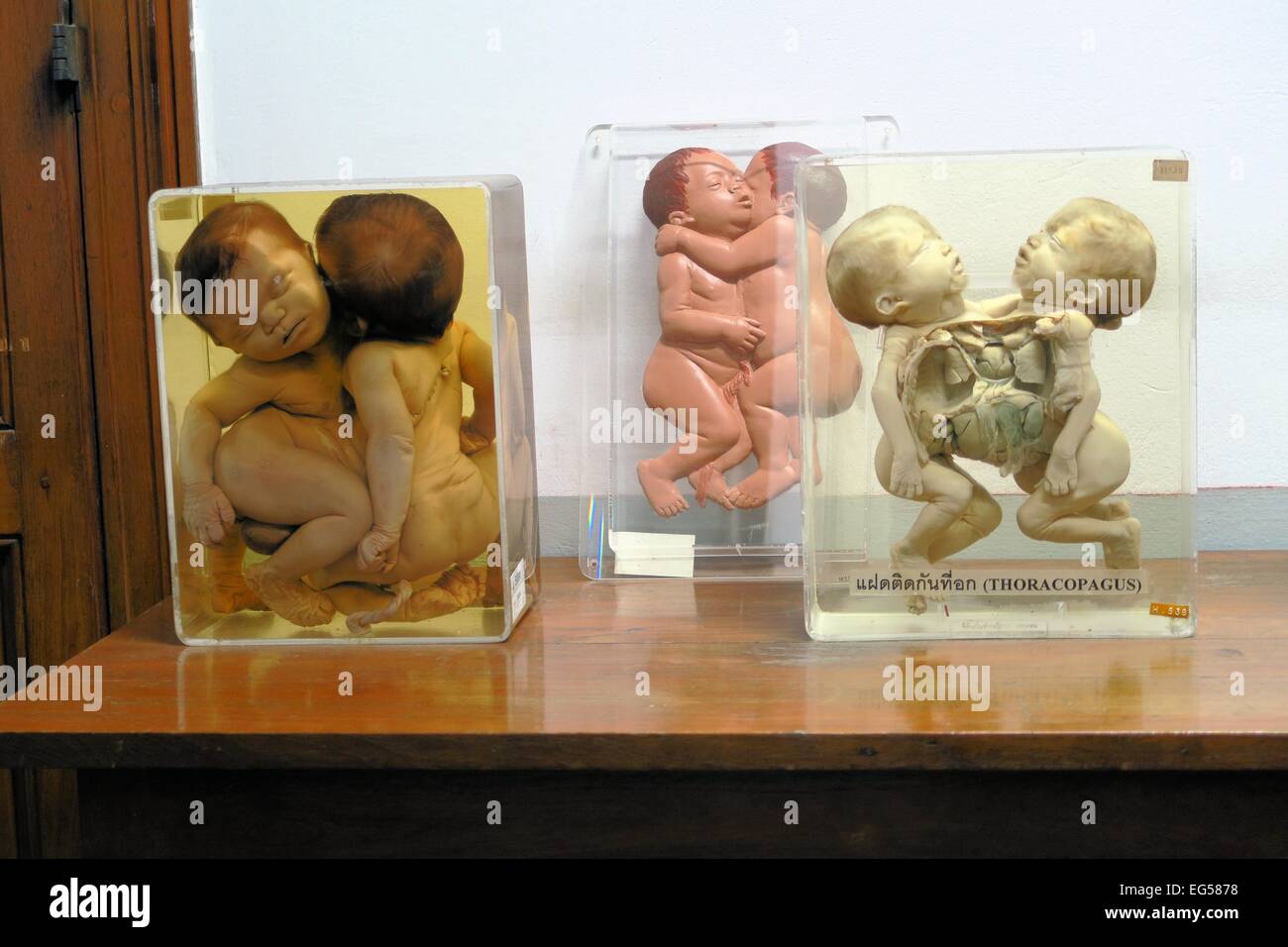 Jumeaux siamois Forensic exposition dans une exposition des médicaments de médecine légale Banque D'Images