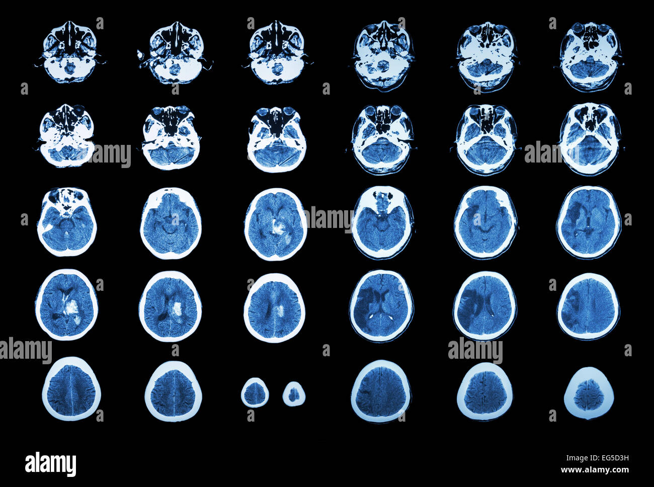 L'accident vasculaire cérébral hémorragique et ischémique Accident vasculaire cérébral . CT scan de cerveau : l'hémorragie intracérébrale ( 3 ) de la colonne de gauche, infarctus cérébral ( 3 Banque D'Images