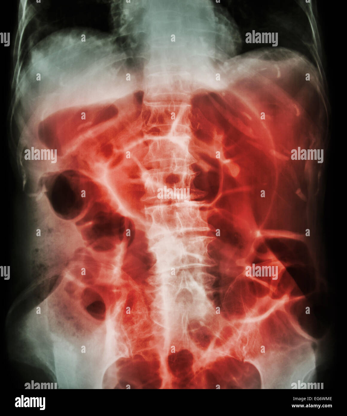L'obstruction intestinale ( X-ray abdomen dos : gros intestin se dilatent en raison d'une occlusion intestinale due au cancer du colon) Banque D'Images