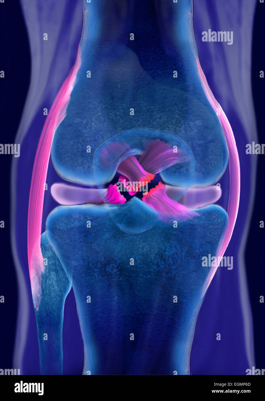 La rupture des ligaments croisés du genou, les deux, illustration Banque D'Images