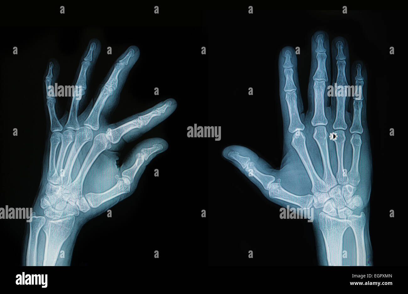 X-ray mains et des doigts Banque D'Images