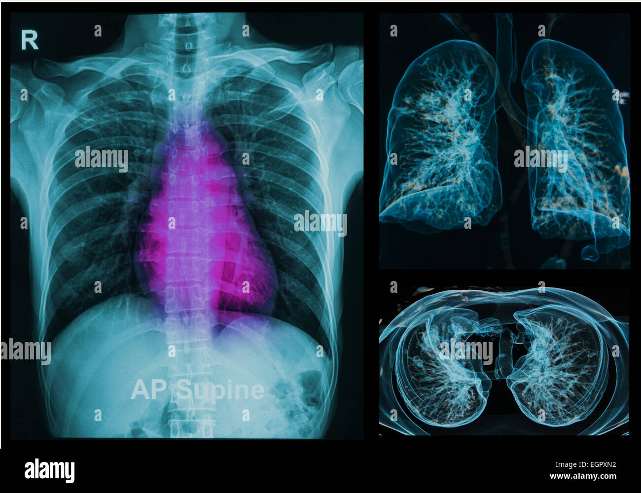 Les radiographies en vertu de l'image 3D ,poumons image 3D Banque D'Images