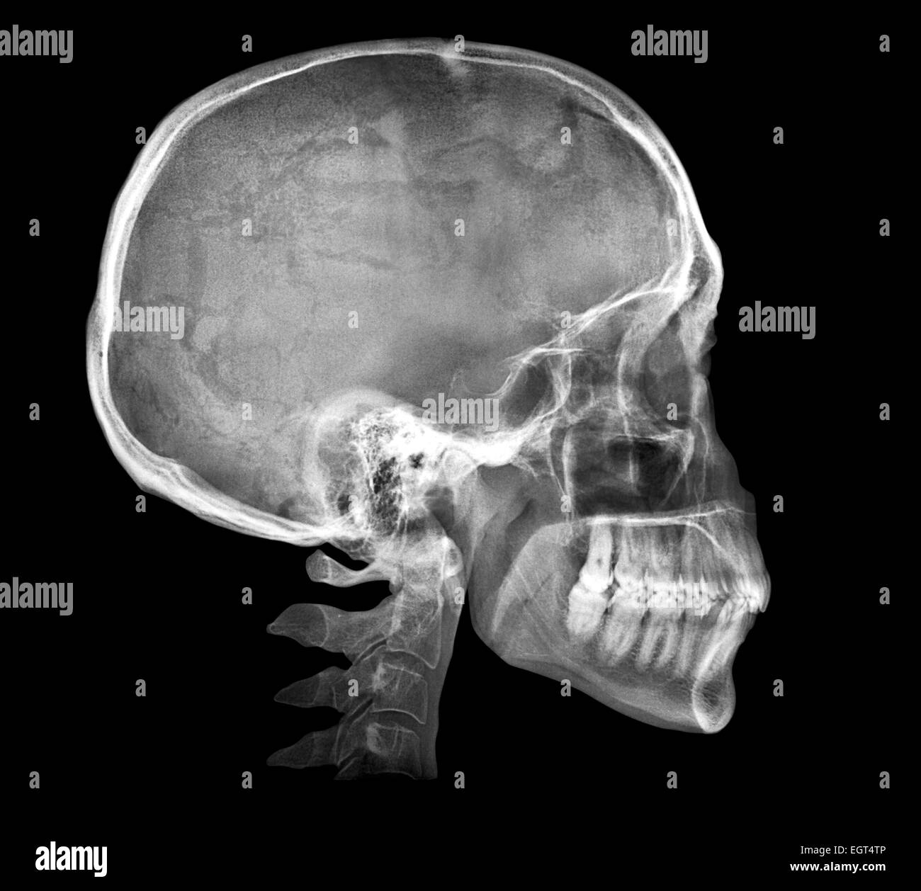 Crâne humain X-ray image isolated on black Banque D'Images