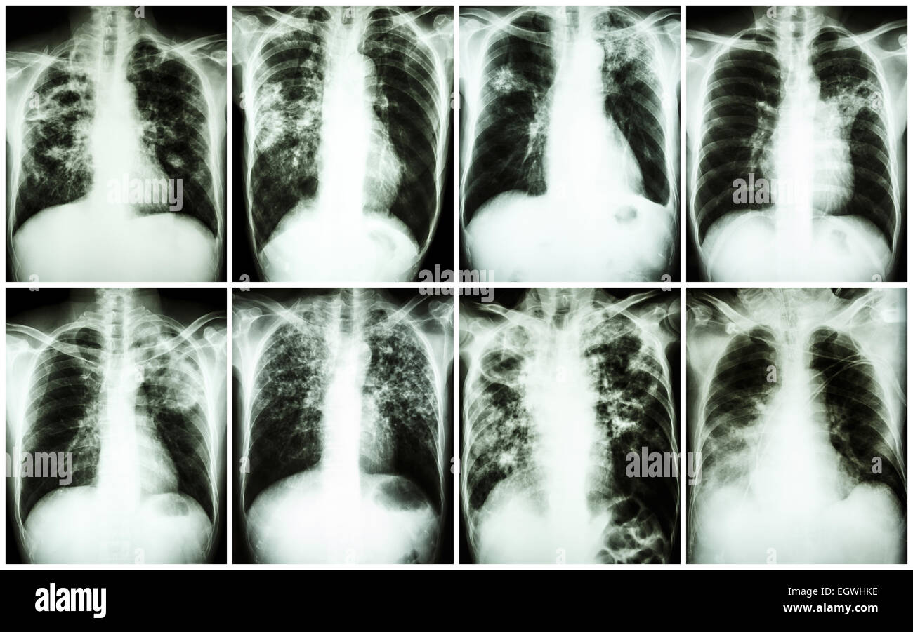 La tuberculose pulmonaire Collection . La radiographie du thorax : montrer l'infiltration inégale , , l'infiltration infiltration interstitielle alvéolaire Banque D'Images