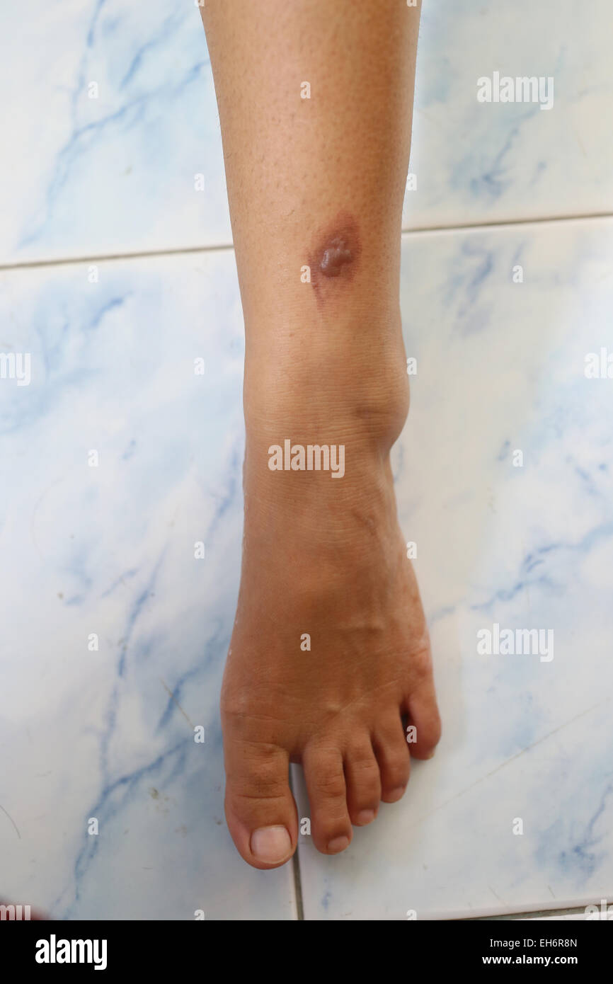 Cloques sur la jambe de la femme. Banque D'Images Cloques sur la jambe de la femme. Banque D'Images
