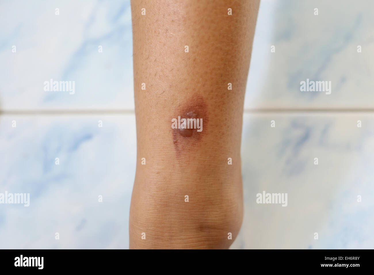 Cloques sur la jambe de la femme. Banque D'Images Cloques sur la jambe de la femme. Banque D'Images