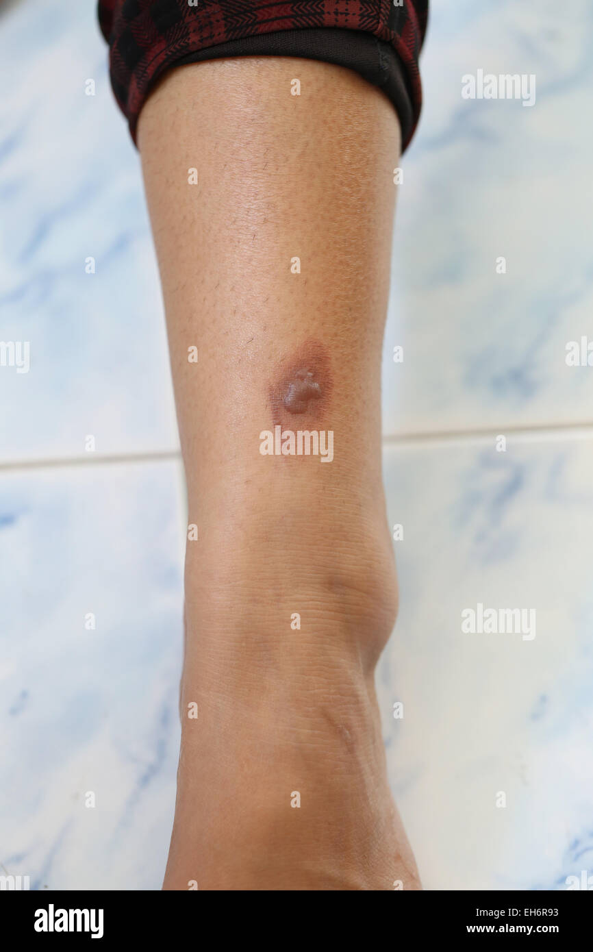 Cloques sur la jambe de la femme. Banque D'Images Cloques sur la jambe de la femme. Banque D'Images
