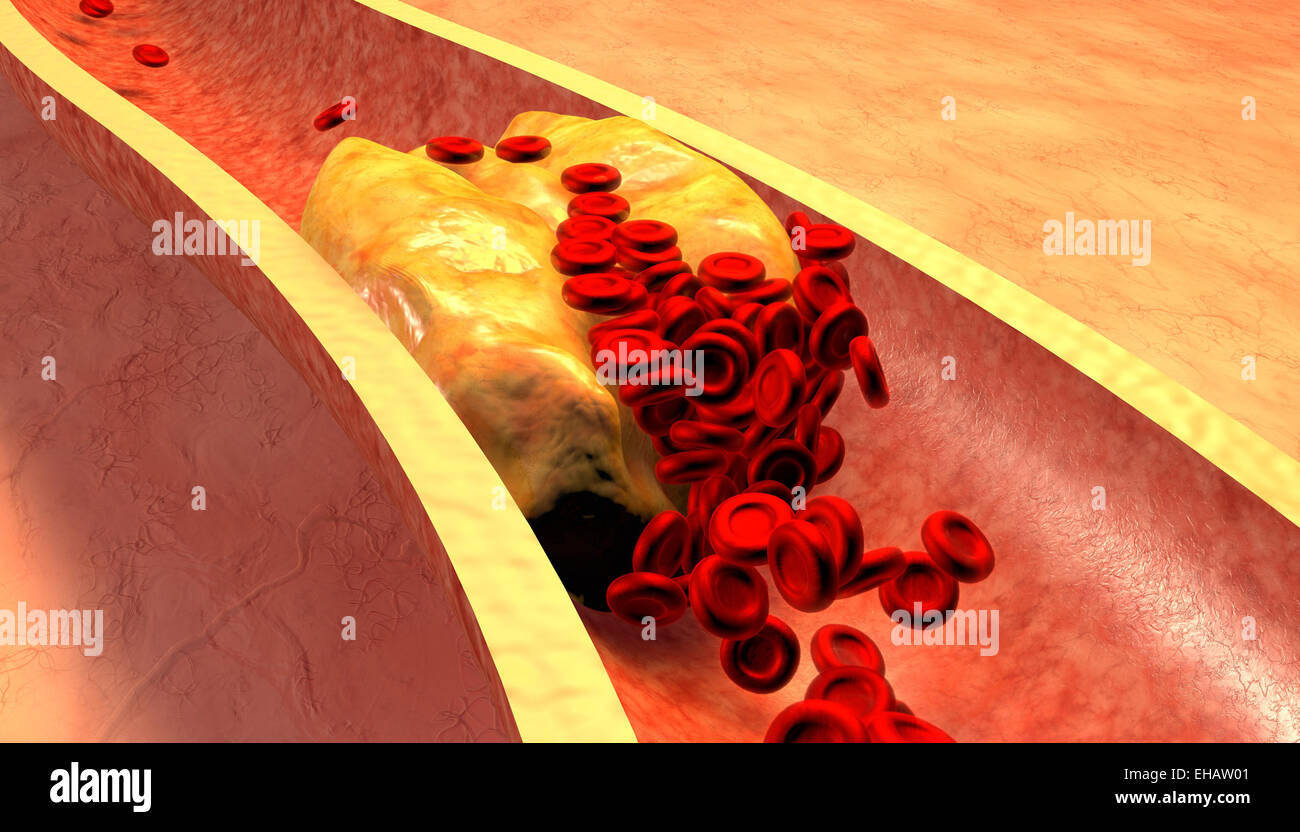 L'artère bouchée avec les plaquettes et la plaque de cholestérol Banque D'Images