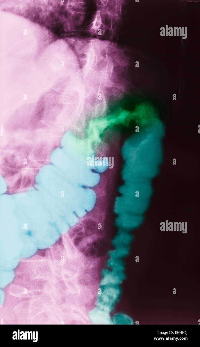 Renforcement de couleur radiographie d'un patient atteint de cancer du côlon. Banque D'Images