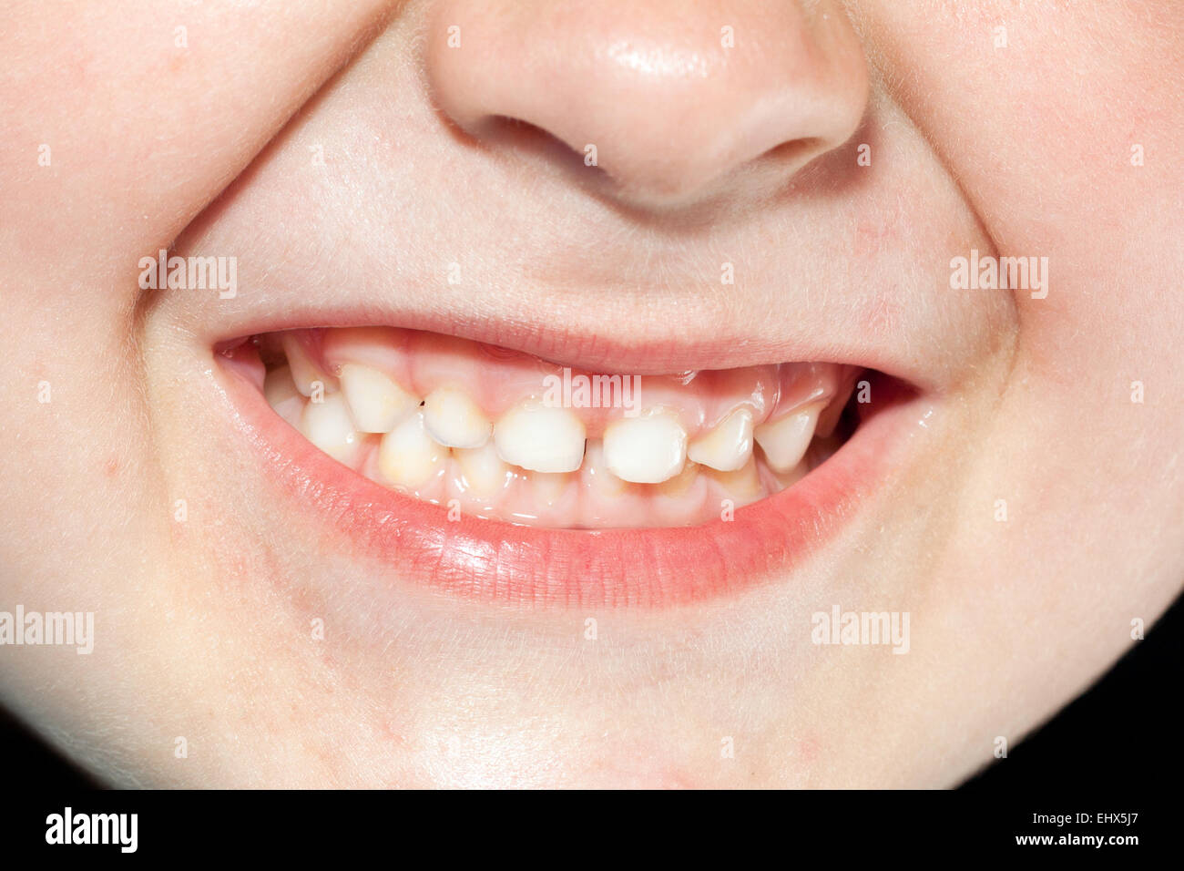 Les dents des enfants close up Banque D'Images