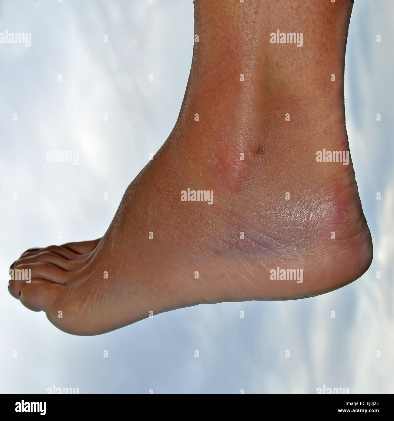 L'enflure et les ecchymoses causées par une entorse à la cheville Banque D'Images