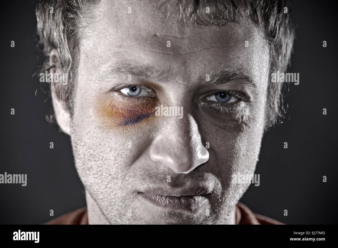 Œil meurtri. Banque D'Images