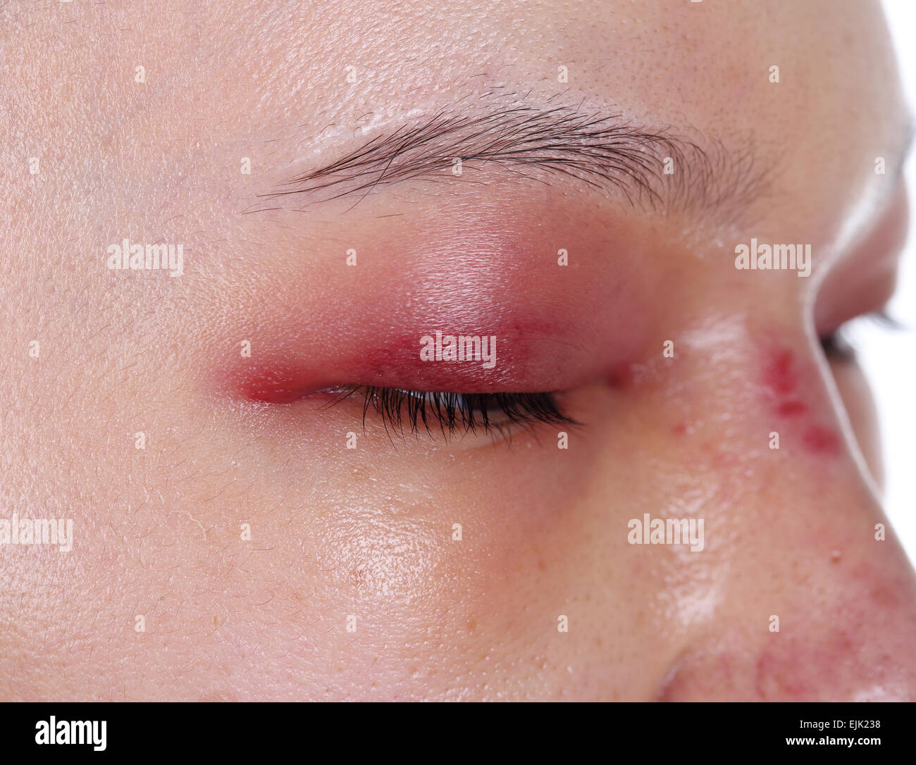 Closeup de gonflement paupière supérieure après le travail de nez