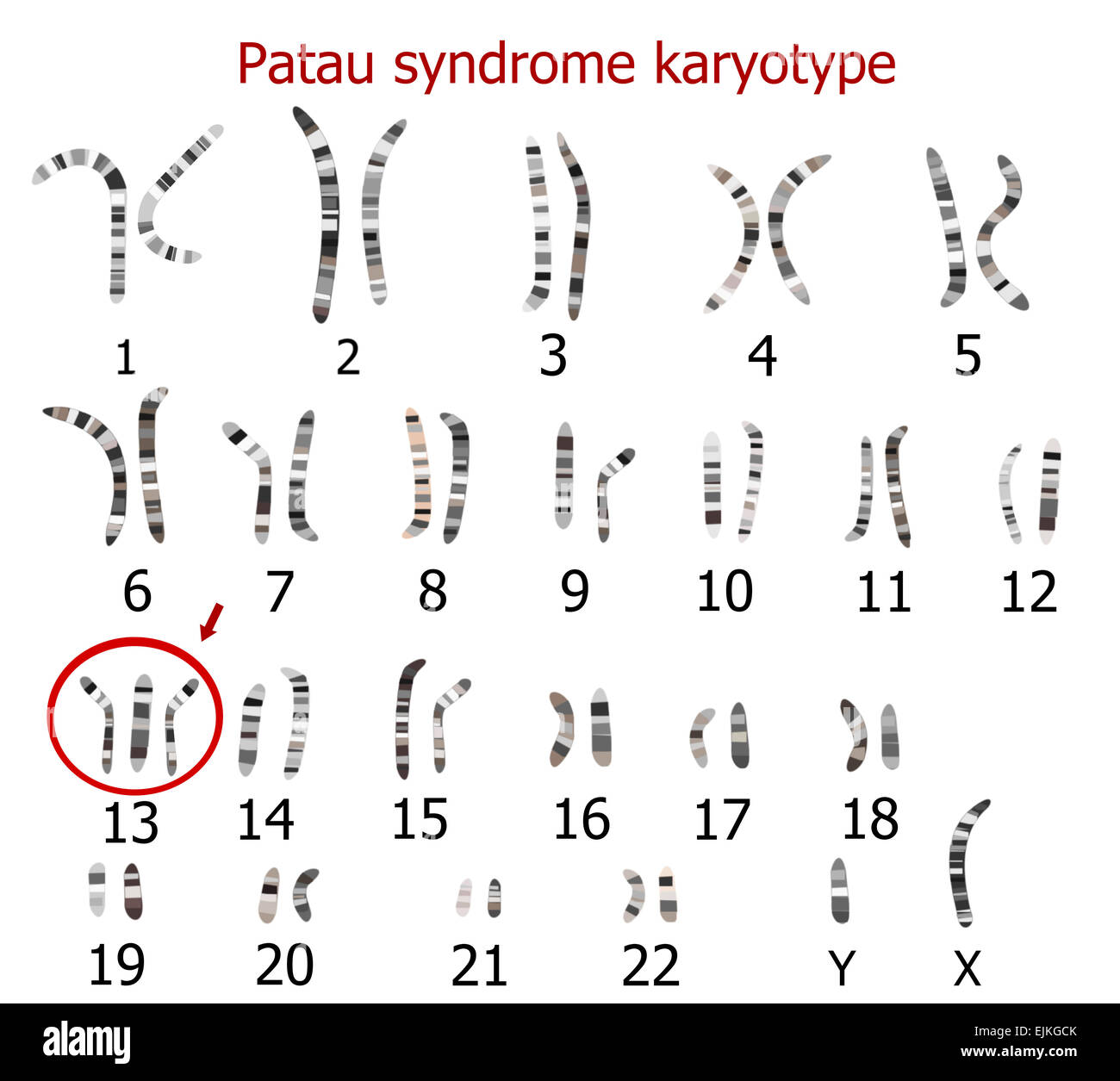 Caryotype syndrome de Patau (trisomie 13) Banque D'Images