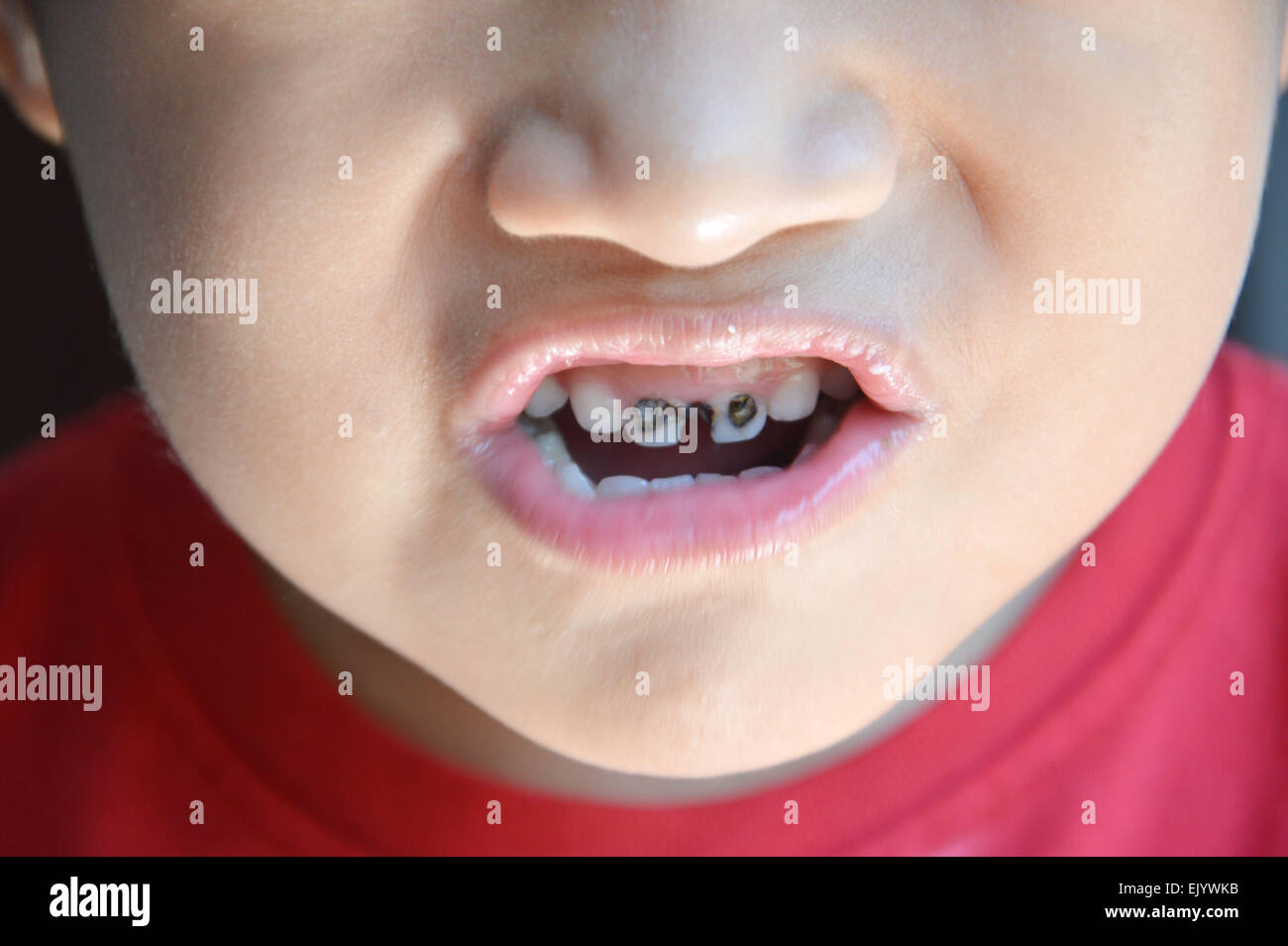 La Carie Dentaire Pour Enfants Photo Stock Alamy