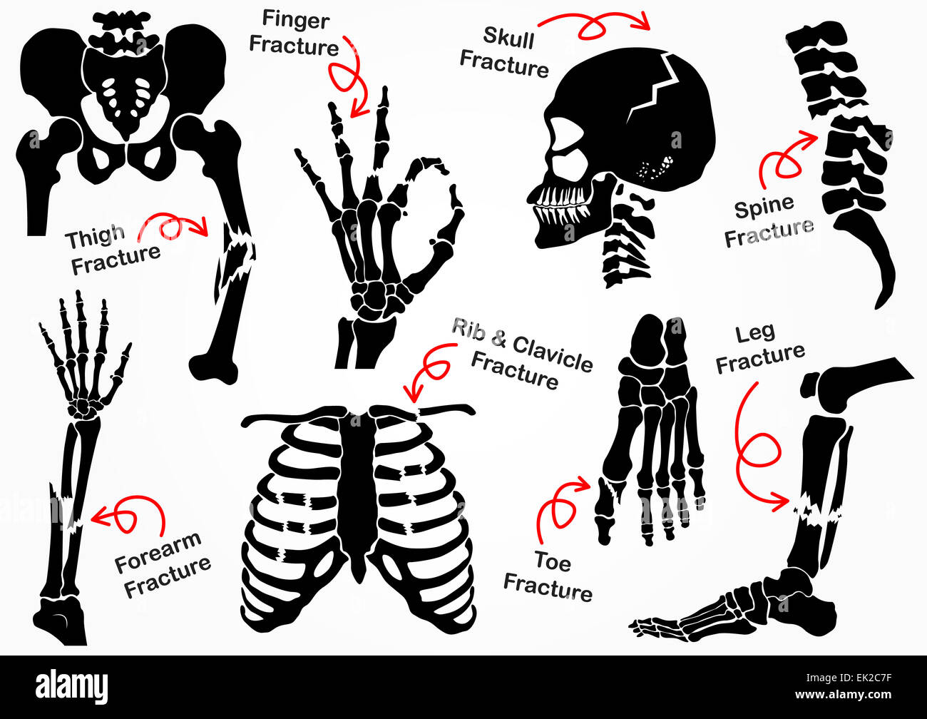Définir l'icône Fracture des os pelviens ( , , La Hanche Cuisse ( fémur ) , Main , Bracelet , FABRICANTS , Crâne , Face , vertèbre , le coude , Thorax Banque D'Images