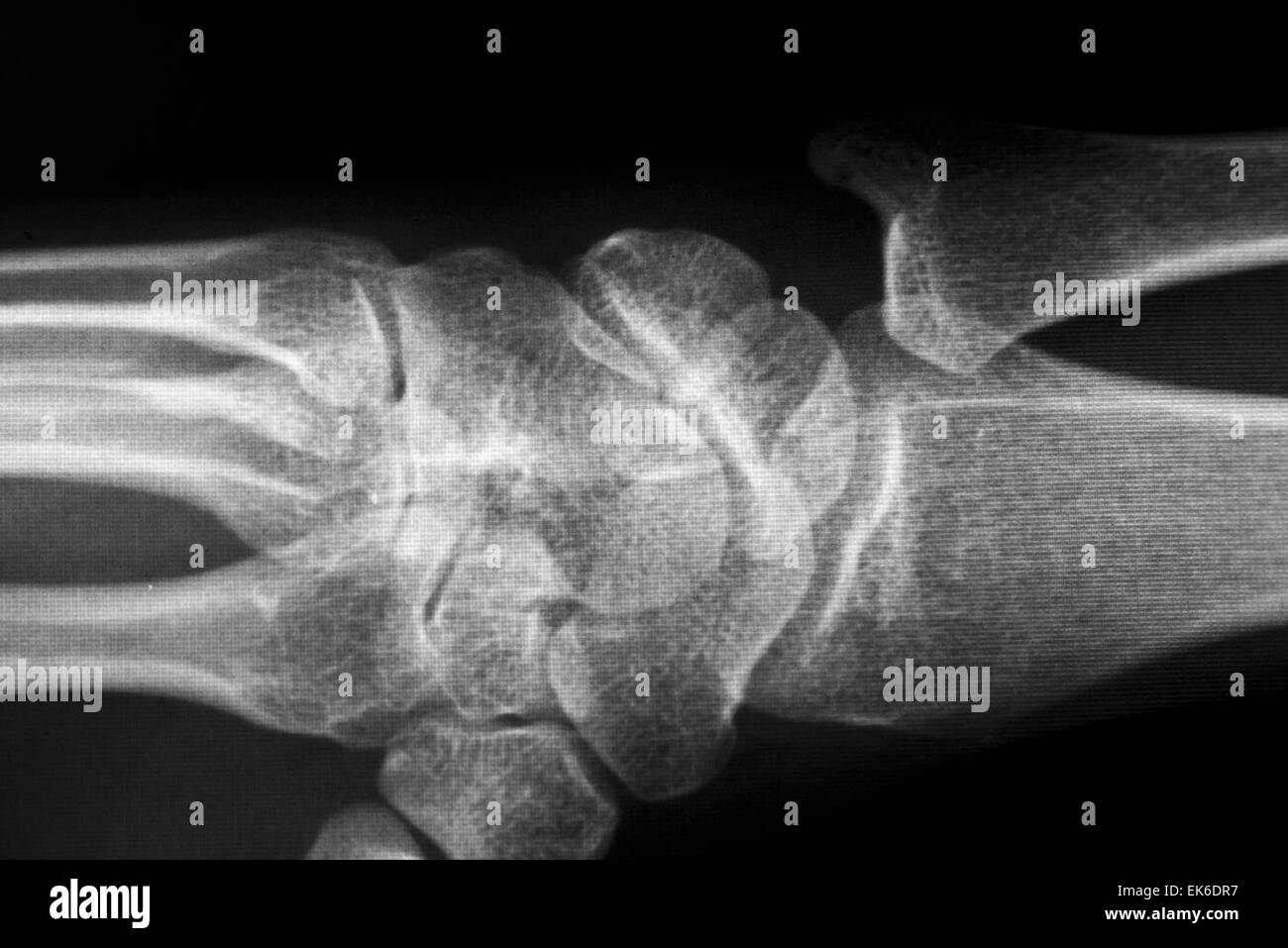 X-Ray de syndrome du canal carpien et l'os métacarpien de la main de l'Homme Banque D'Images