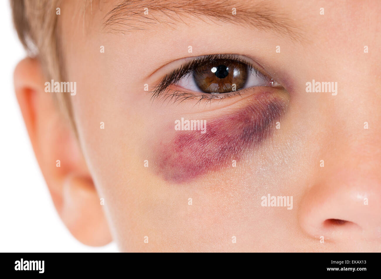 Garçon avec ecchymose Banque D'Images