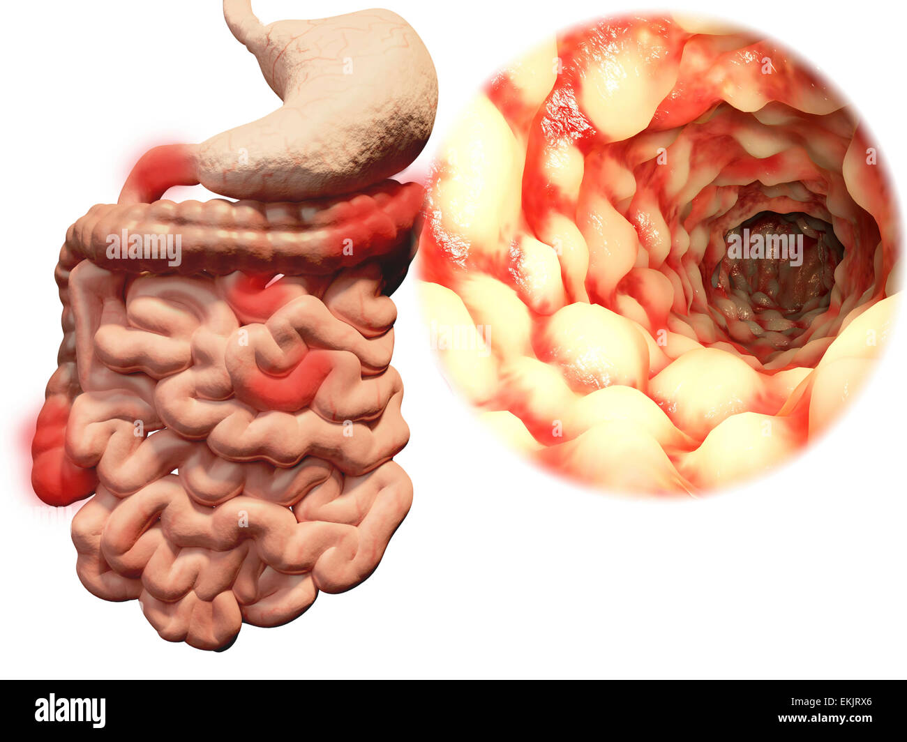 Inflammatory bowel disease Banque de photographies et d'images à haute  résolution - Alamy