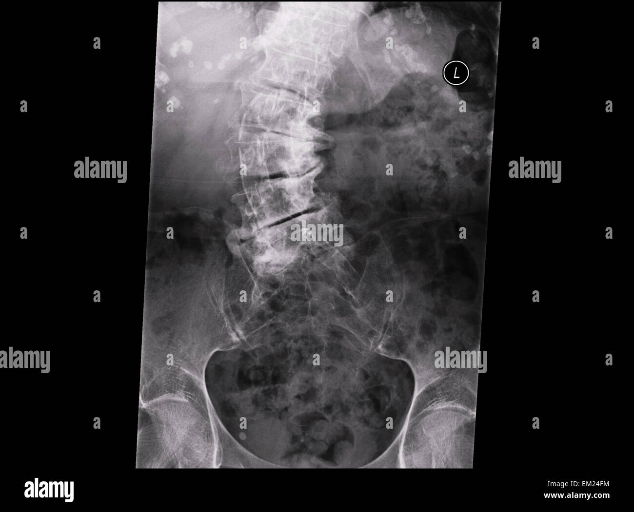 La scoliose du rachis d'une femme âgée à l'ostéoporose, maladie des rayons x Banque D'Images