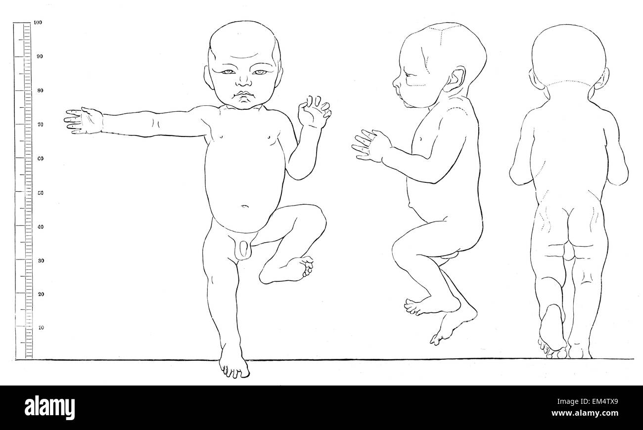 Proportions d'un enfant nouveau-né (après l'Schwadow ) Banque D'Images